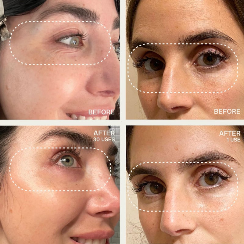 Dermaclara Silicone Patch Face Rejuvenation Kit - Anti-Wrinkle Patches for Forehead, Smile Lines, Silicone Frown Line Treatment, Up to 30 Uses- 1 Forehead, 4 Mouth & Eye, 1 Neck & 1 Cleanser - Image 3
